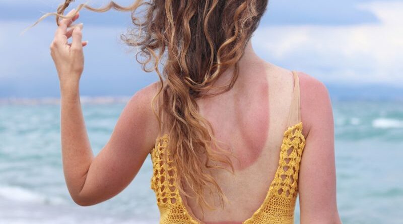 Vrouw met lang krullend haar en een door de zon verbrande rode rug bij zee, passend bij natuurlijke tips voor na het zonnen.